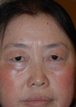 Blepharoplasty before at Woodbury Plastic Surgery, David Thao, MD in Woodbury, MN