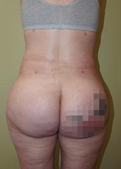 Brazilian Butt Lift after at Woodbury Plastic Surgery, David Thao, MD in Woodbury, MN