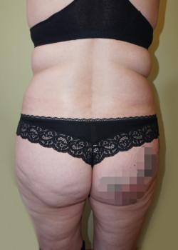Brazilian Butt Lift before at Woodbury Plastic Surgery, David Thao, MD in Woodbury, MN