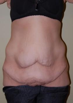 Mini Tummy Tuck before at Woodbury Plastic Surgery, David Thao, MD in Woodbury, MN