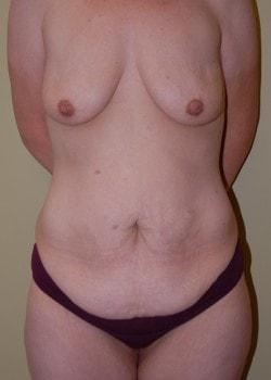 Mommy Makeover before at Woodbury Plastic Surgery, David Thao, MD in Woodbury, MN