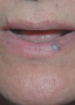 Laser Skin Resurfacing before at Woodbury Plastic Surgery, David Thao, MD in Woodbury, MN