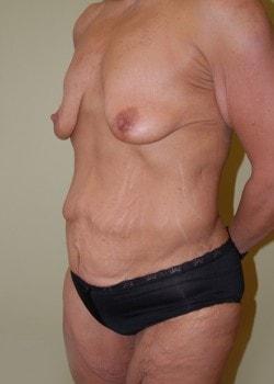Mommy Makeover before at Woodbury Plastic Surgery, David Thao, MD in Woodbury, MN