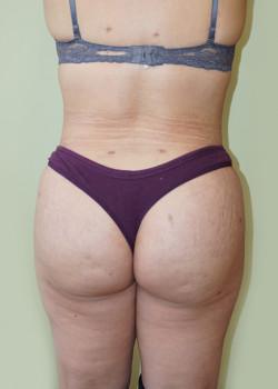 Woodbury Plastic Surgery, David Thao, MD after — Woodbury, MN