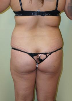 Brazilian Butt Lift before at Woodbury Plastic Surgery, David Thao, MD in Woodbury, MN