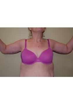 Arm Lift after at Woodbury Plastic Surgery, David Thao, MD in Woodbury, MN