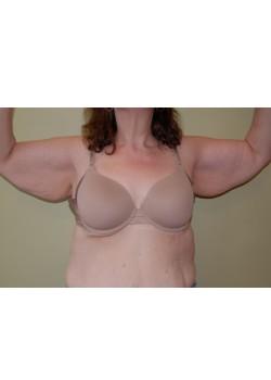 Arm Lift before at Woodbury Plastic Surgery, David Thao, MD in Woodbury, MN
