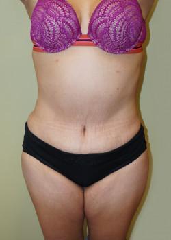 Mini Tummy Tuck after at Woodbury Plastic Surgery, David Thao, MD in Woodbury, MN