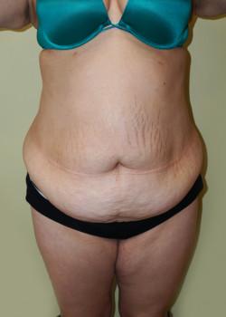Mini Tummy Tuck before at Woodbury Plastic Surgery, David Thao, MD in Woodbury, MN