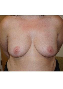 Breast Reduction after at Woodbury Plastic Surgery, David Thao, MD in Woodbury, MN