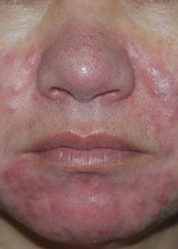 Laser Skin Resurfacing before at Woodbury Plastic Surgery, David Thao, MD in Woodbury, MN