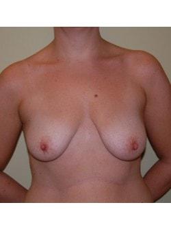 Breast Lift before at Woodbury Plastic Surgery, David Thao, MD in Woodbury, MN