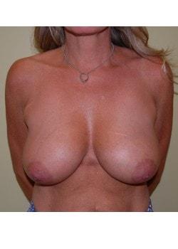 Breast Reduction before at Woodbury Plastic Surgery, David Thao, MD in Woodbury, MN