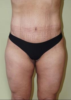 Woodbury Plastic Surgery, David Thao, MD thigh lift after — Woodbury, MN