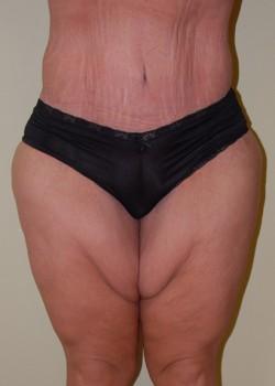 Thigh Lift before at Woodbury Plastic Surgery, David Thao, MD in Woodbury, MN