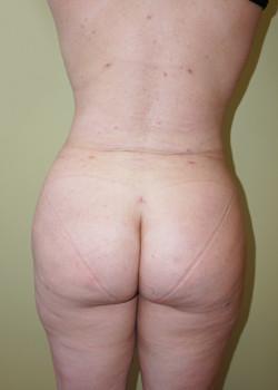 Woodbury Plastic Surgery, David Thao, MD after — Woodbury, MN