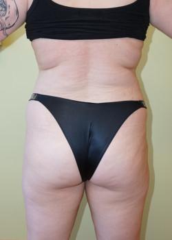 Brazilian Butt Lift before at Woodbury Plastic Surgery, David Thao, MD in Woodbury, MN
