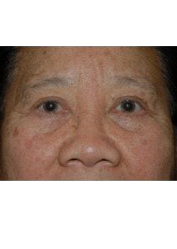 Blepharoplasty after at Woodbury Plastic Surgery, David Thao, MD in Woodbury, MN