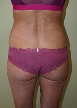 Brazilian Butt Lift before at Woodbury Plastic Surgery, David Thao, MD in Woodbury, MN