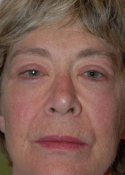 Blepharoplasty after at Woodbury Plastic Surgery, David Thao, MD in Woodbury, MN