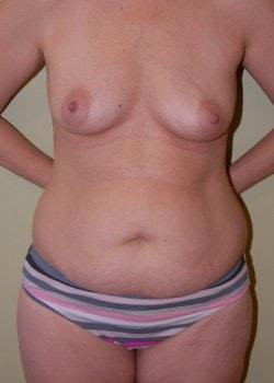 Mommy Makeover before at Woodbury Plastic Surgery, David Thao, MD in Woodbury, MN