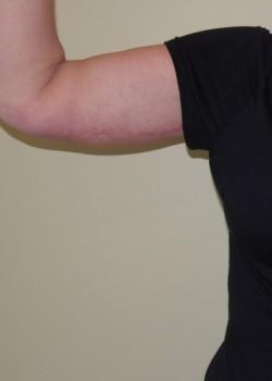 Arm Lift after at Woodbury Plastic Surgery, David Thao, MD in Woodbury, MN