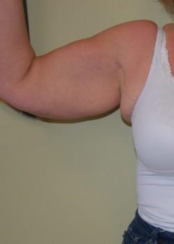 Arm Lift before at Woodbury Plastic Surgery, David Thao, MD in Woodbury, MN