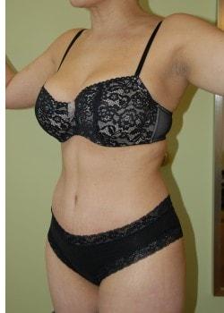 Woodbury Plastic Surgery, David Thao, MD tummy tuck after — Woodbury, MN