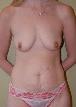 Mommy Makeover before at Woodbury Plastic Surgery, David Thao, MD in Woodbury, MN