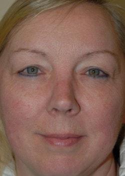 Blepharoplasty after at Woodbury Plastic Surgery, David Thao, MD in Woodbury, MN