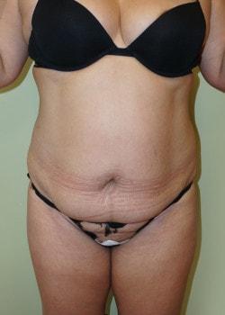 Mini Tummy Tuck before at Woodbury Plastic Surgery, David Thao, MD in Woodbury, MN