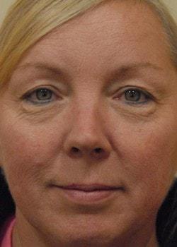 Blepharoplasty before at Woodbury Plastic Surgery, David Thao, MD in Woodbury, MN