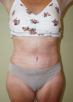 Woodbury Plastic Surgery, David Thao, MD tummy tuck after — Woodbury, MN