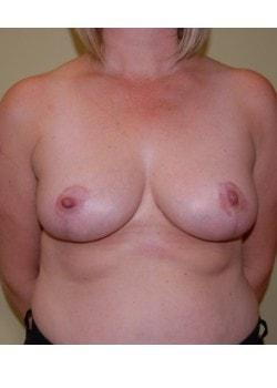 Breast Reduction after at Woodbury Plastic Surgery, David Thao, MD in Woodbury, MN