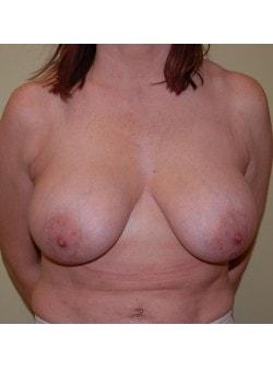Breast Lift before at Woodbury Plastic Surgery, David Thao, MD in Woodbury, MN