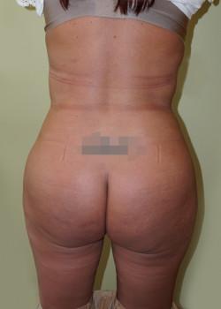 Liquid BBL after at Woodbury Plastic Surgery, David Thao, MD in Woodbury, MN
