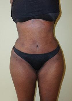 Mini Tummy Tuck after at Woodbury Plastic Surgery, David Thao, MD in Woodbury, MN
