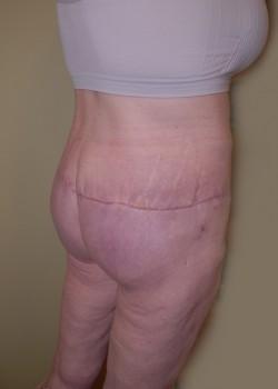 Thigh Lift after at Woodbury Plastic Surgery, David Thao, MD in Woodbury, MN