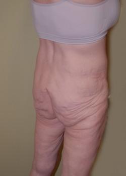 Thigh Lift before at Woodbury Plastic Surgery, David Thao, MD in Woodbury, MN