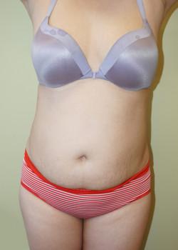 Breast Augmentation before at Woodbury Plastic Surgery, David Thao, MD in Woodbury, MN