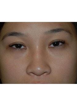Laser Skin Resurfacing after at Woodbury Plastic Surgery, David Thao, MD in Woodbury, MN