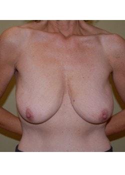 Breast Lift before at Woodbury Plastic Surgery, David Thao, MD in Woodbury, MN