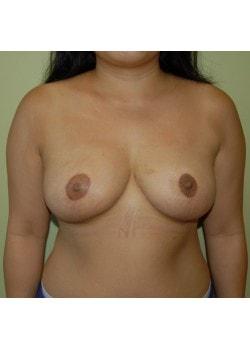 Breast Reduction after at Woodbury Plastic Surgery, David Thao, MD in Woodbury, MN