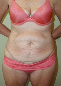 Mini Tummy Tuck before at Woodbury Plastic Surgery, David Thao, MD in Woodbury, MN