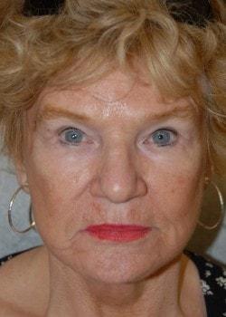 Mini Facelift after at Woodbury Plastic Surgery, David Thao, MD in Woodbury, MN