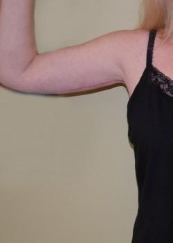 Arm Lift after at Woodbury Plastic Surgery, David Thao, MD in Woodbury, MN
