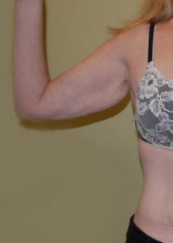 Arm Lift before at Woodbury Plastic Surgery, David Thao, MD in Woodbury, MN