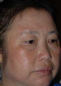 Blepharoplasty after at Woodbury Plastic Surgery, David Thao, MD in Woodbury, MN