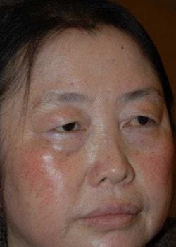 Blepharoplasty before at Woodbury Plastic Surgery, David Thao, MD in Woodbury, MN