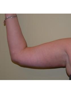 Arm Lift after at Woodbury Plastic Surgery, David Thao, MD in Woodbury, MN